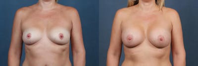 Enlargement - Silicone Before & After Gallery - Patient 144776 - Image 1