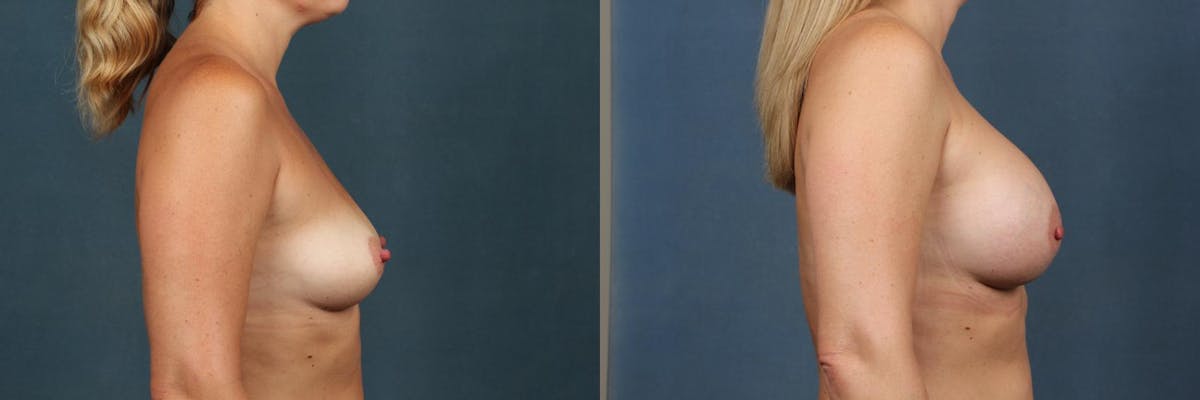 Enlargement - Silicone Before & After Gallery - Patient 144776 - Image 3