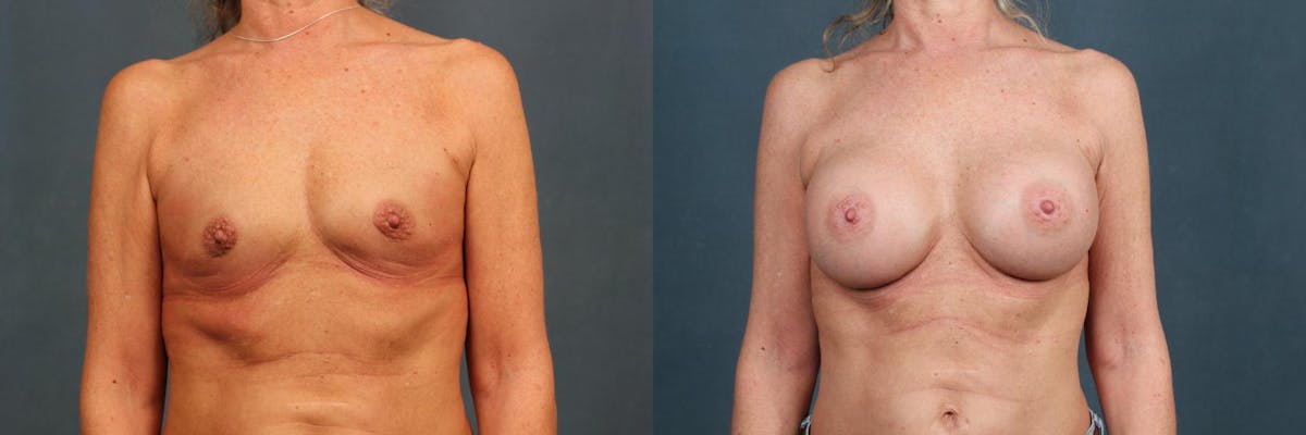 Enlargement - Silicone Before & After Gallery - Patient 153323 - Image 1