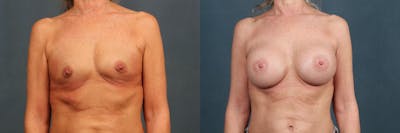 Enlargement - Silicone Before & After Gallery - Patient 153323 - Image 1