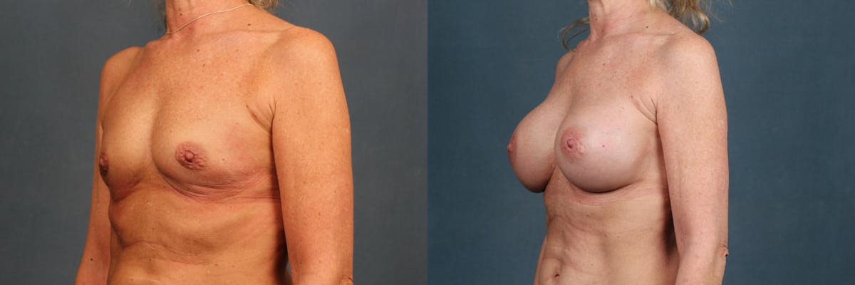 Enlargement - Silicone Before & After Gallery - Patient 153323 - Image 2