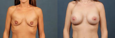 Enlargement - Silicone Before & After Gallery - Patient 275727 - Image 1