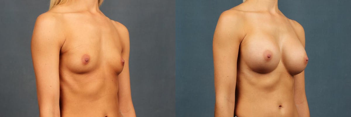 Enlargement - Silicone Before & After Gallery - Patient 298283 - Image 4