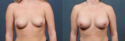 Enlargement - Silicone Before & After Gallery - Patient 293026 - Image 1