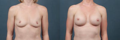 Enlargement - Silicone Before & After Gallery - Patient 113374 - Image 1