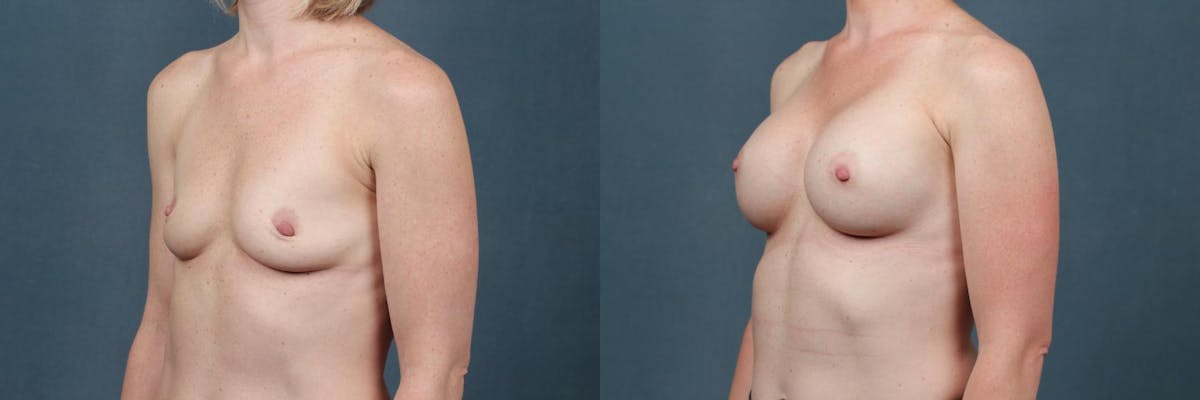Enlargement - Silicone Before & After Gallery - Patient 113374 - Image 2