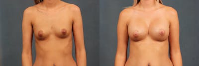 Enlargement - Silicone Before & After Gallery - Patient 245019 - Image 1