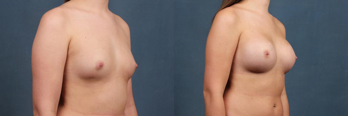 Enlargement - Silicone Before & After Gallery - Patient 413799 - Image 2