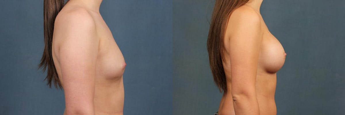 Enlargement - Silicone Before & After Gallery - Patient 413799 - Image 3