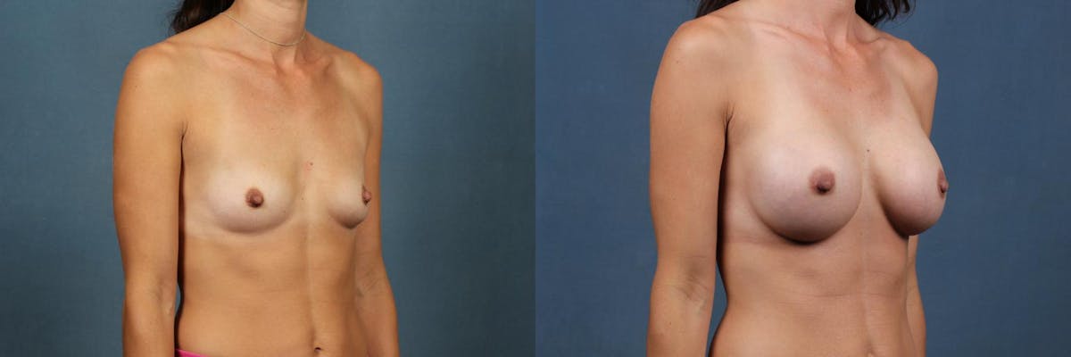 Enlargement - Silicone Before & After Gallery - Patient 304189 - Image 4