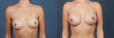 Enlargement - Silicone Before & After Gallery - Patient 101148 - Image 1