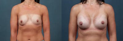 Enlargement - Silicone Before & After Gallery - Patient 131685 - Image 1