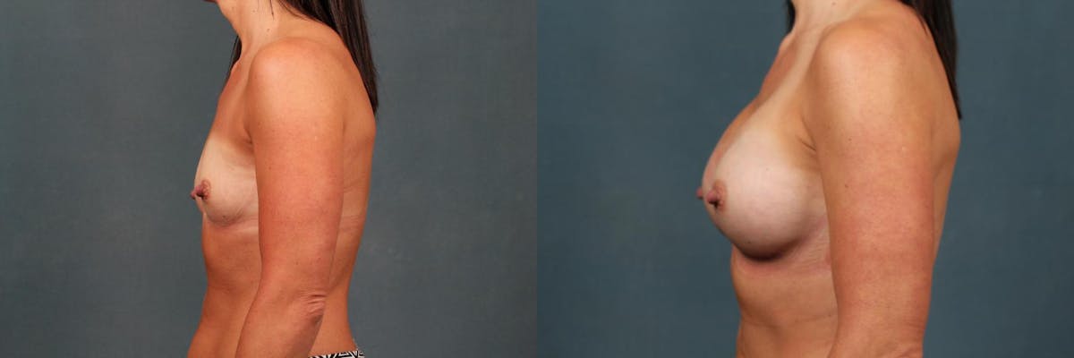 Enlargement - Silicone Before & After Gallery - Patient 131685 - Image 3