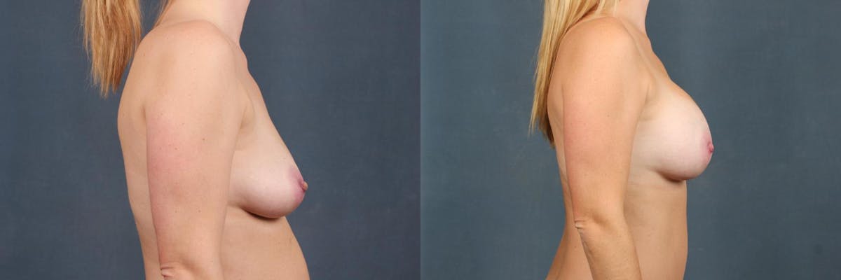 Enlargement - Silicone Before & After Gallery - Patient 148992 - Image 3