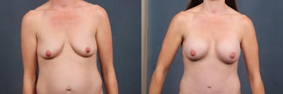 Enlargement - Silicone Before & After Gallery - Patient 336002 - Image 1