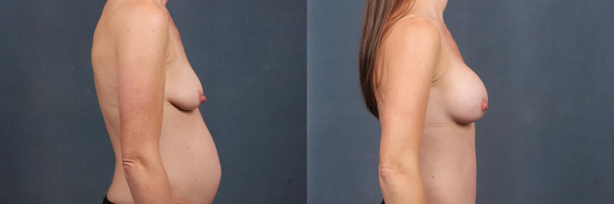 Enlargement - Silicone Before & After Gallery - Patient 336002 - Image 3