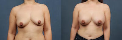 Enlargement - Silicone Before & After Gallery - Patient 381579 - Image 1