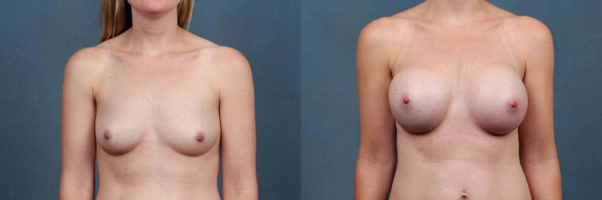 Enlargement - Silicone Before & After Gallery - Patient 425131 - Image 1