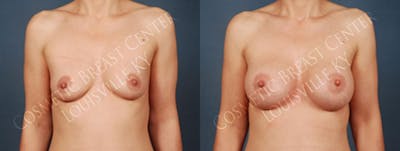 Enlargement - Silicone Before & After Gallery - Patient 127438 - Image 1