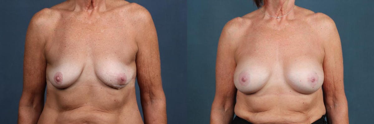 Enlargement - Silicone Before & After Gallery - Patient 275133 - Image 1