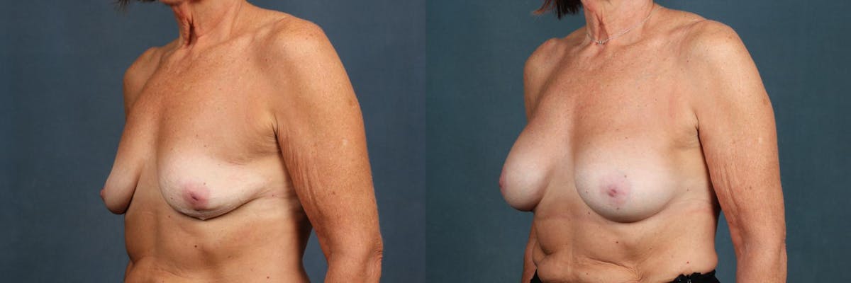 Enlargement - Silicone Before & After Gallery - Patient 275133 - Image 2