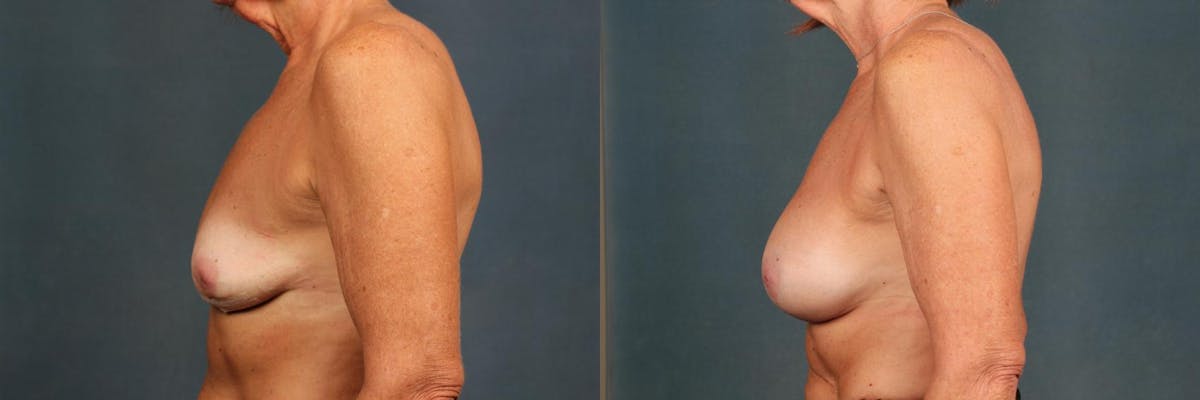 Enlargement - Silicone Before & After Gallery - Patient 275133 - Image 3