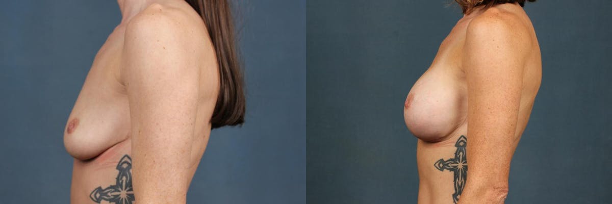 Enlargement - Silicone Before & After Gallery - Patient 830923 - Image 3