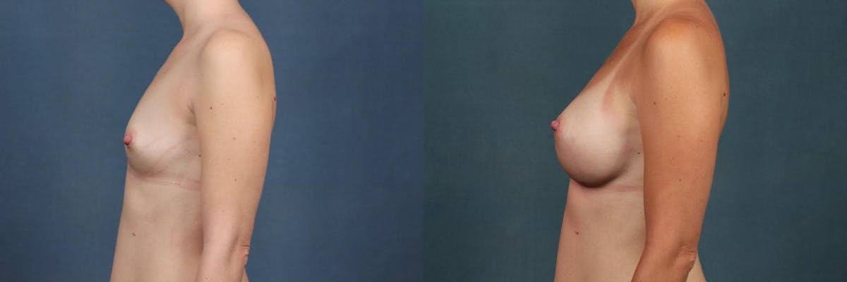 Enlargement - Silicone Before & After Gallery - Patient 331336 - Image 2