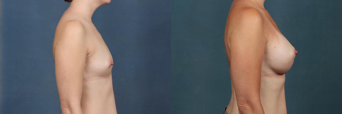 Enlargement - Silicone Before & After Gallery - Patient 331336 - Image 4