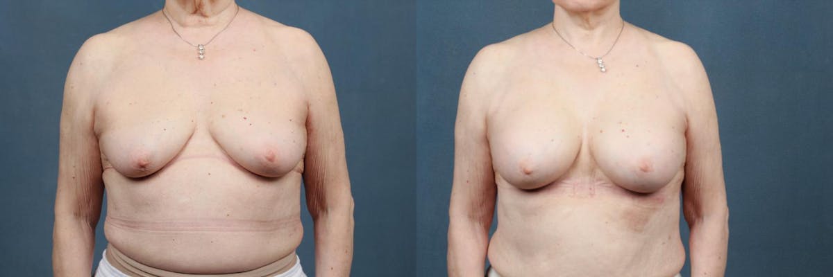 Enlargement - Silicone Before & After Gallery - Patient 110679 - Image 1