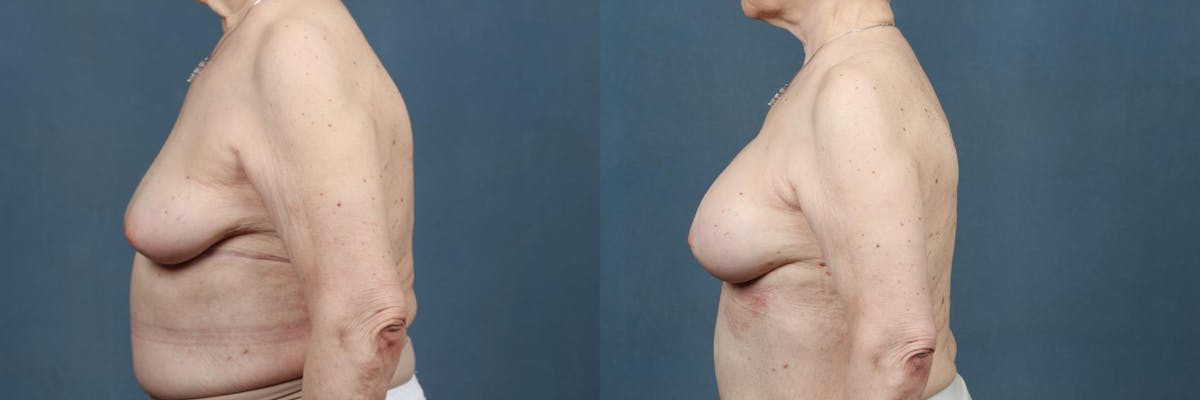 Enlargement - Silicone Before & After Gallery - Patient 110679 - Image 3