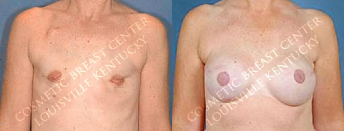 Reconstruction Before & After Gallery - Patient 237862 - Image 1