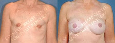 Reconstruction Before & After Gallery - Patient 237862 - Image 1