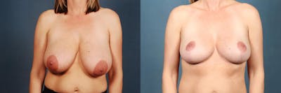 Reduction Before & After Gallery - Patient 185265 - Image 1