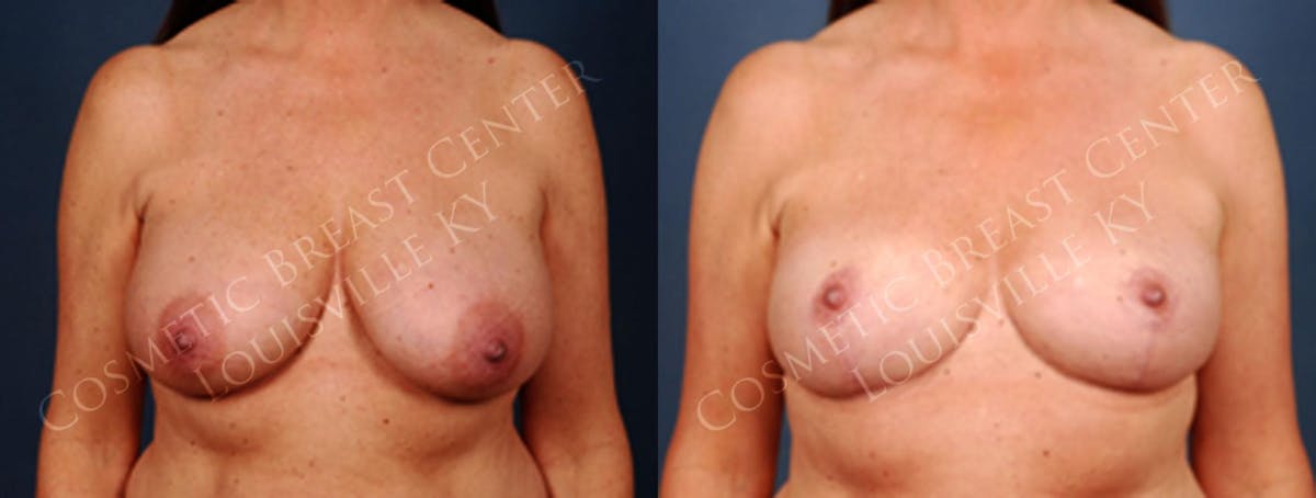 Reduction Before & After Gallery - Patient 256693 - Image 1