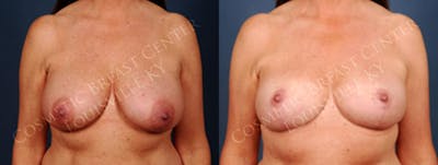 Reduction Before & After Gallery - Patient 256693 - Image 1