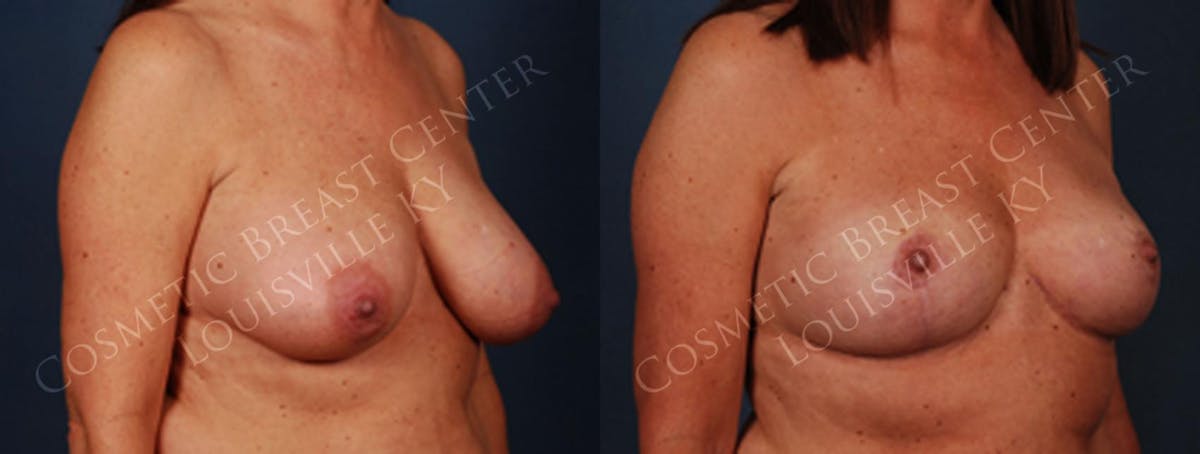 Reduction Before & After Gallery - Patient 256693 - Image 2