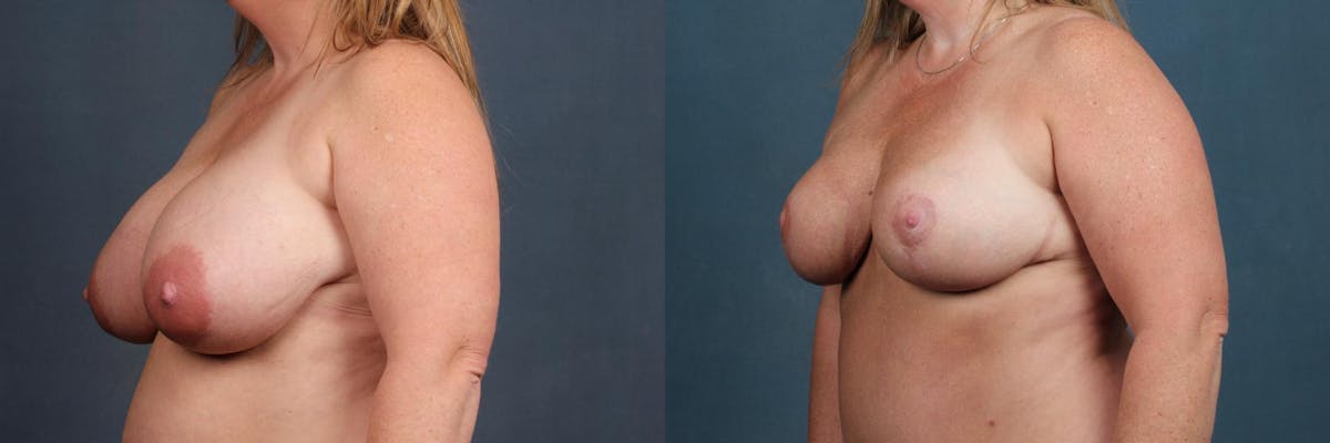 Reduction Before & After Gallery - Patient 227349 - Image 2