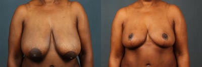 Reduction Before & After Gallery - Patient 334173 - Image 1