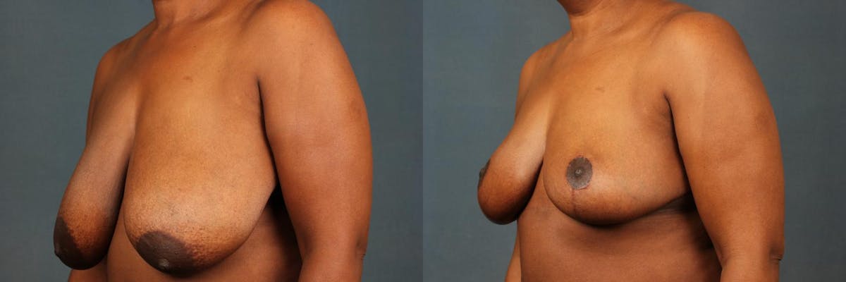 Reduction Before & After Gallery - Patient 334173 - Image 2