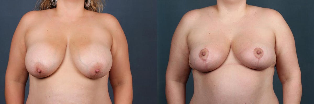 Reduction Before & After Gallery - Patient 162628 - Image 1