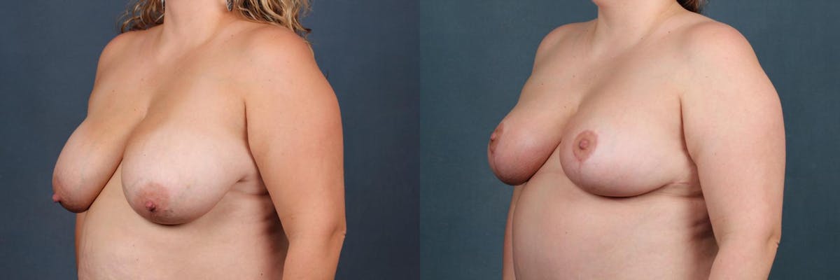 Reduction Before & After Gallery - Patient 162628 - Image 2