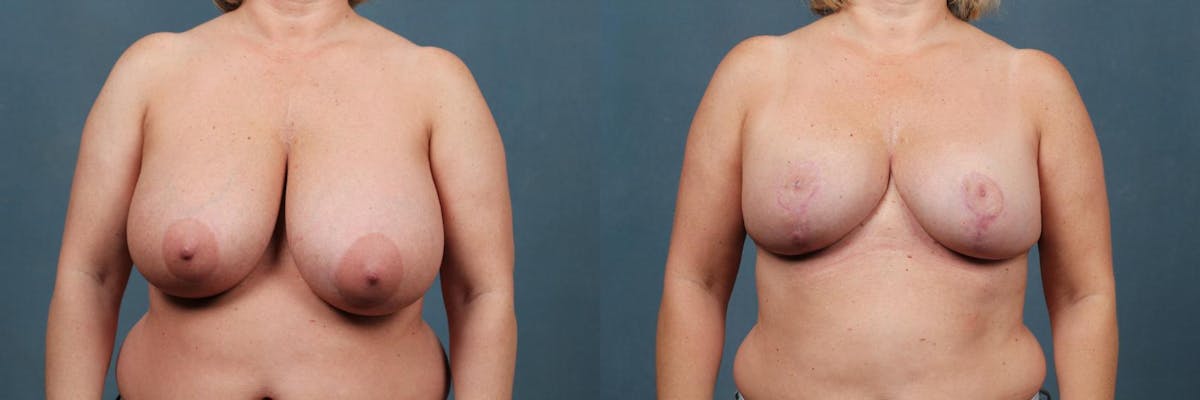Reduction Before & After Gallery - Patient 331476 - Image 1