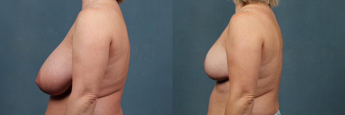 Reduction Before & After Gallery - Patient 331476 - Image 3