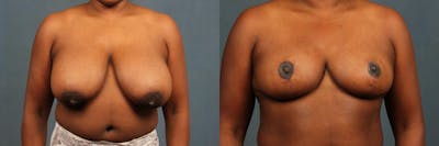 Reduction Before & After Gallery - Patient 306626 - Image 1