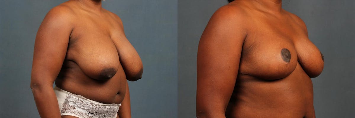 Reduction Before & After Gallery - Patient 306626 - Image 4