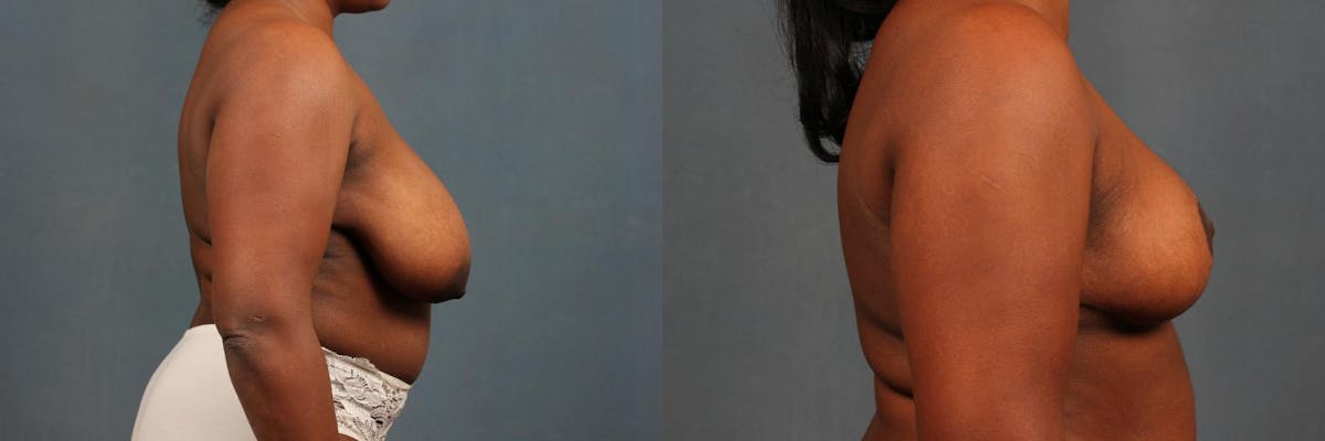 Reduction Before & After Gallery - Patient 306626 - Image 5