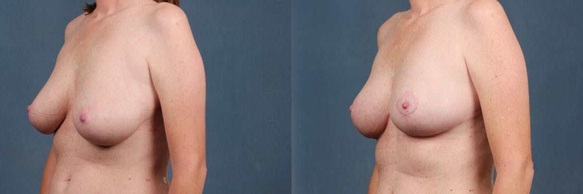 Reduction Before & After Gallery - Patient 497329 - Image 2