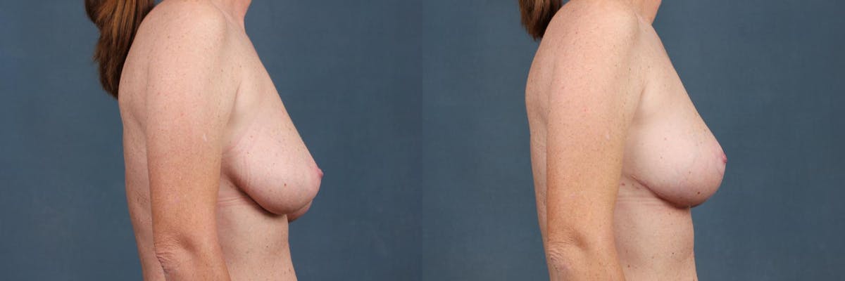 Reduction Before & After Gallery - Patient 497329 - Image 3