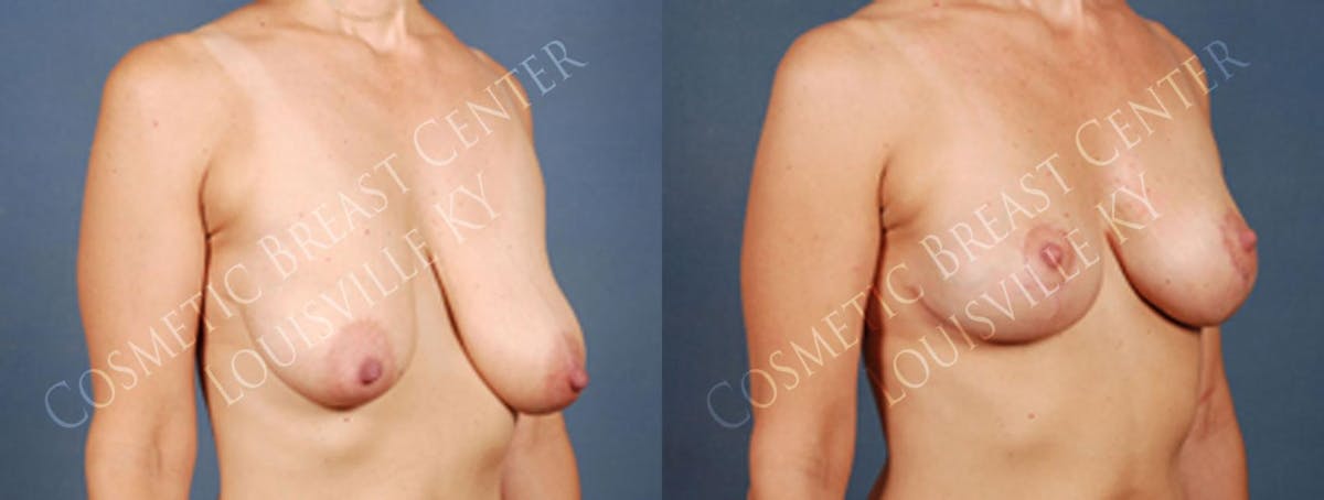 Reduction Before & After Gallery - Patient 288210 - Image 2